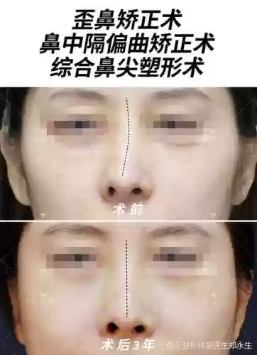 歪鼻子阵容插图1